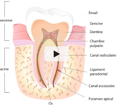 la reprise de traitement de racine (RTE) ou l'implant dental?