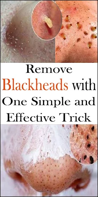 Remove Blackheads With One Simple And Effective Trick