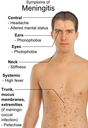 Risk of Death for Patients with Meningitis