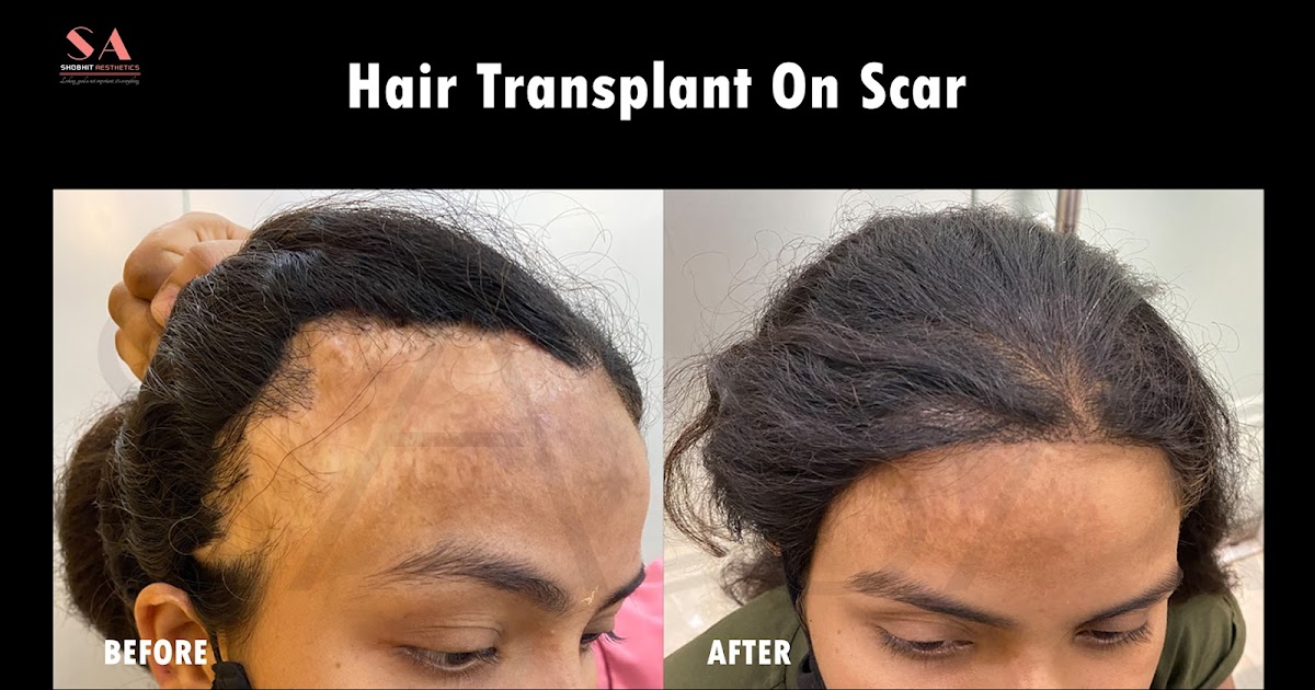 Synthetic Hair Transplant Cost: What You Should Expect?