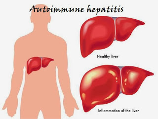 boli hepatice autoimune