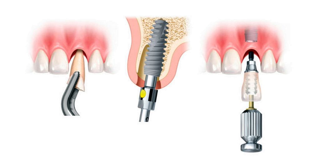 Implantes Dentales