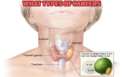 What types of cancers are considered head and neck cancers