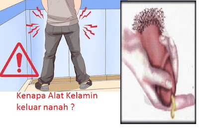  Obat Sakit Penis Keluar Nanah Terasa Saat Kencing Ampuh