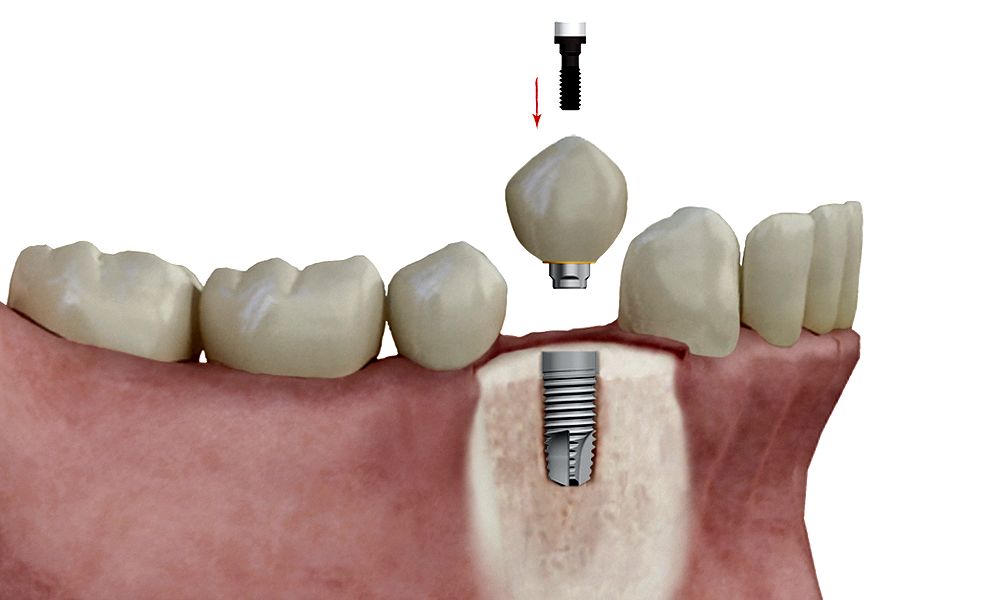 Implantes Dentales