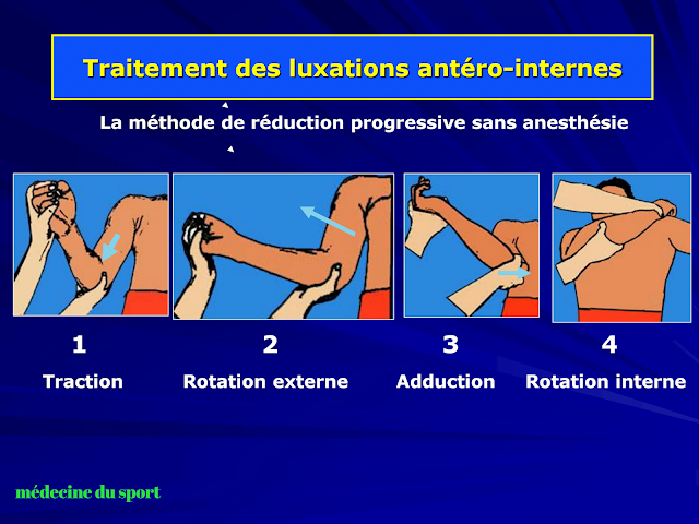 Les Luxations de l’épaule