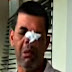  VIDEO – Dominicano se perfora una verruga con una aguja y casi pierde la nariz