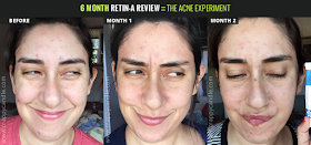 Retin-A Before/After - 6 Month Review :: The Acne Experiment