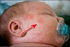Symptoms of rice allergy in infants
