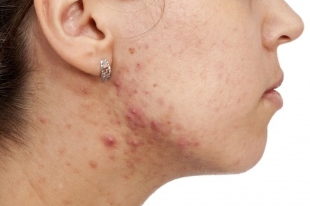 Acne on the Neck Overcome by Easy