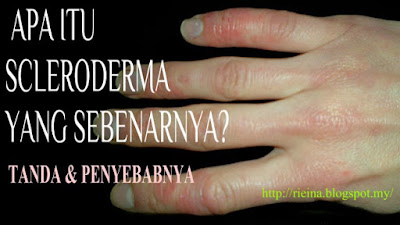 SCLERODERMA