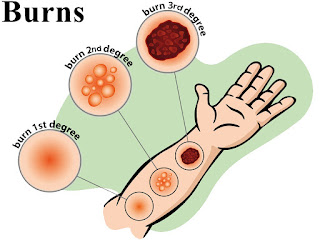 Best herbs for treating burns (Scalds)