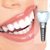 Trồng răng implant ở Cần Thơ ở đâu uy tín?