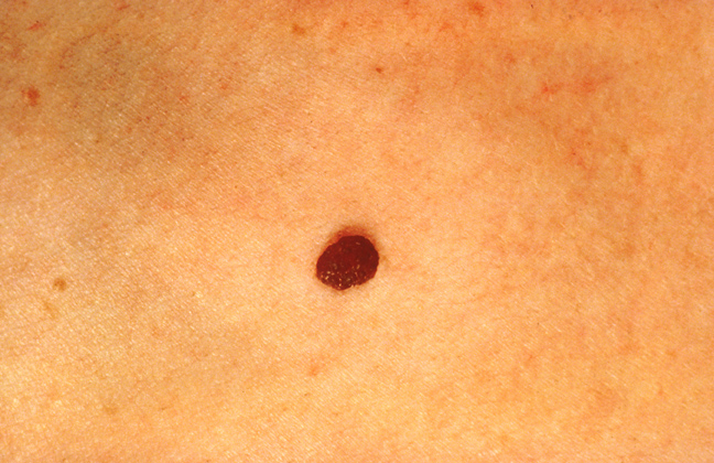 Download Basic Skin Care Tips: Signs Of Skin Cancer Moles And What To Look For
