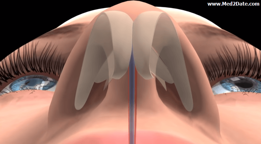 Deviated-nasal-septum-causes-treatment