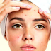 Remove Blackheads from household remedies