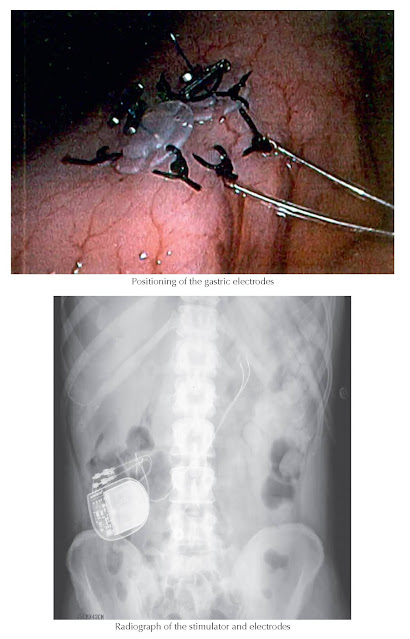 GASTRIC ELECTRICAL STIMULATION FOR GASTROPARESIS