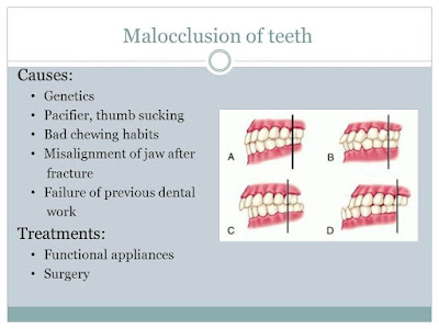 Malocclusion