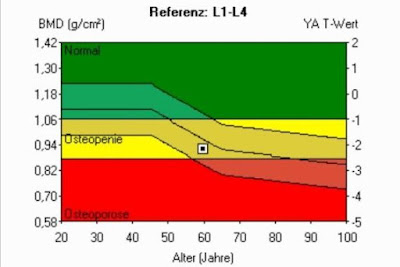 Auswertung einer DXA-Messung bei Osteopenie