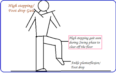 high stepping gait,foot drop gait