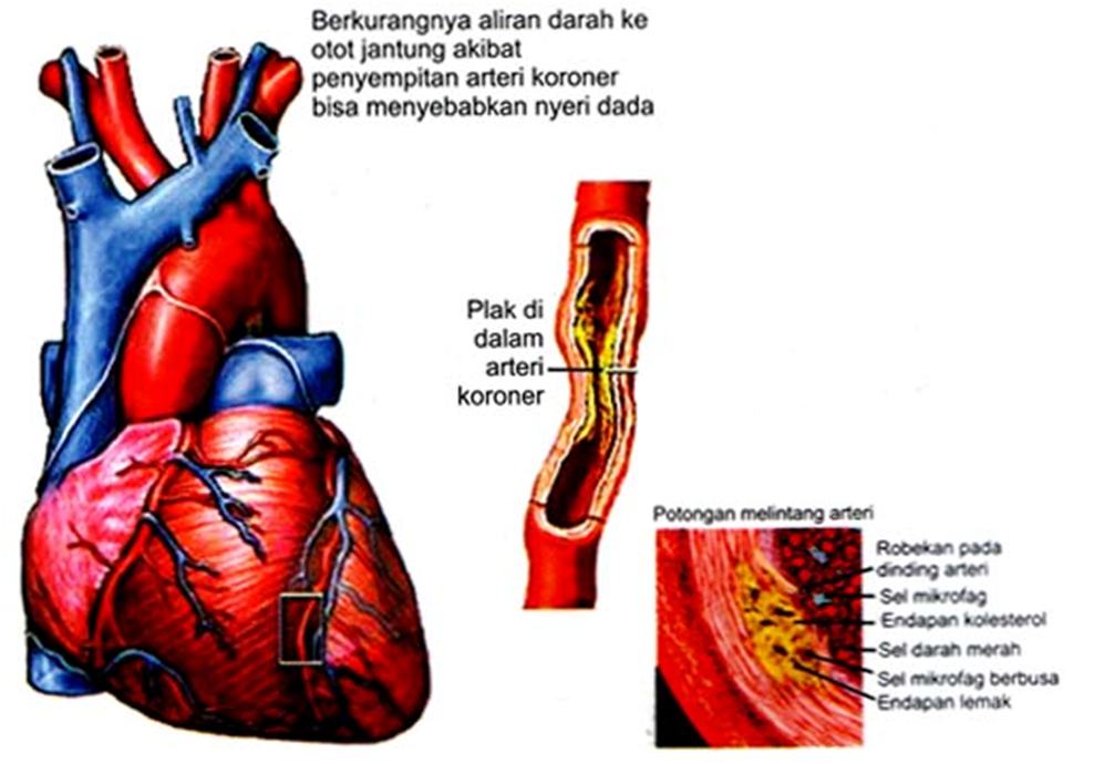 Jenis jenis Penyakit Dalam Penyakit dan Gambar Jantung