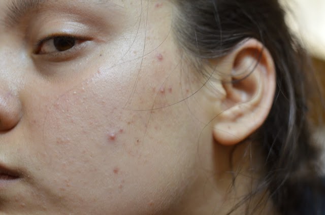 Garnier Pure Active Neem Face Wash - How I conquered acne