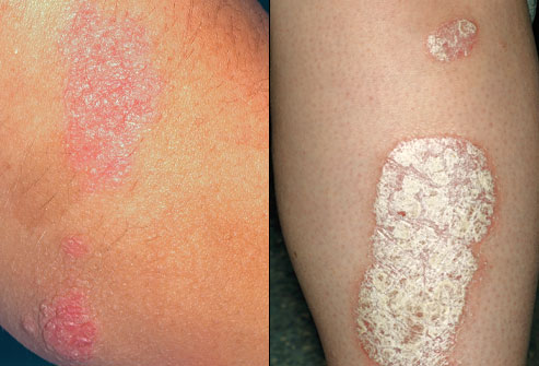 mild poison oak rash pictures. mild poison oak rash pictures.