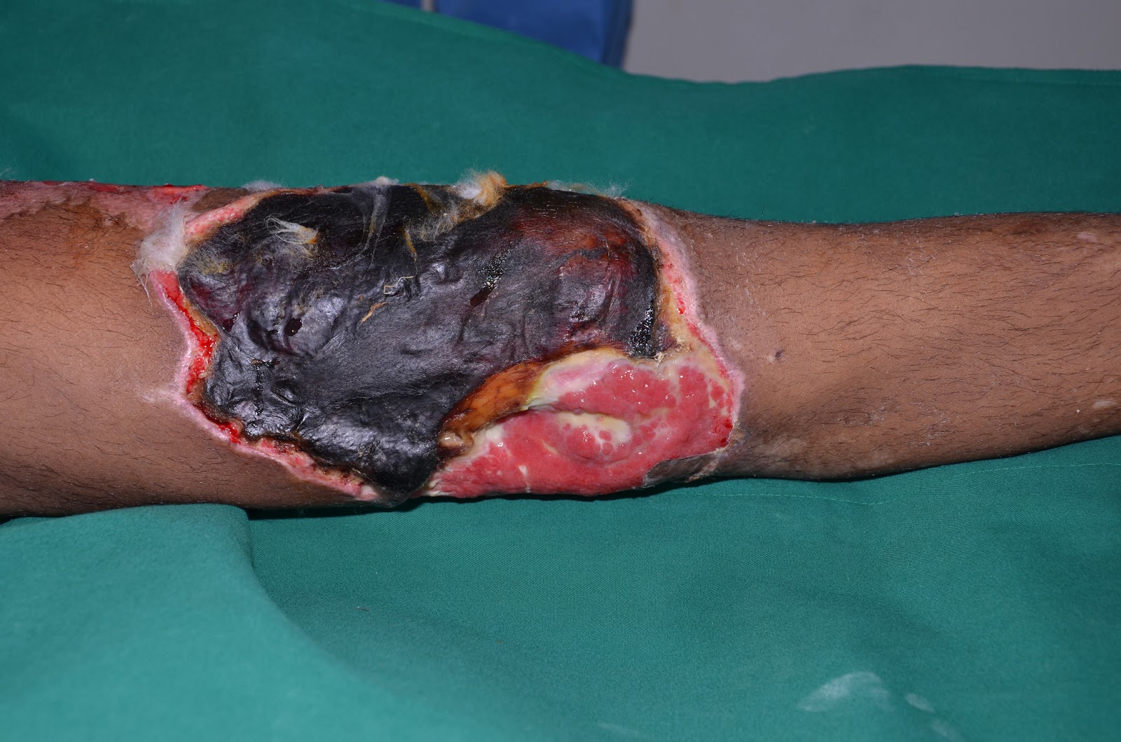 CRUSH INJURY FOOT, LOWER LIMB INJURIES AND LIMB SALVAGE: DEGLOVING INJURY  LEFT LEG AND KNEE - ROLE OF NEGATIVE PRESSURE WOUND THERAPY