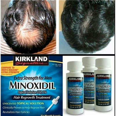 kirkland-hair-regrowth-funciona