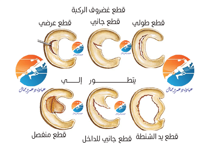 شكل غضروف الركبة