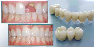 Cầu răng sứ thẩm mỹ-2