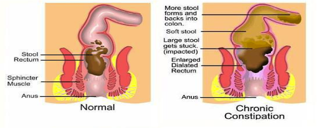 Constipation,Causes, Fiber Foods and Home Remedies