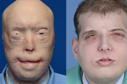 Historical Face Transplant - Fire Fighter is Recovering from Surgery