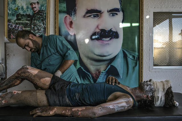 Green Pear Diaries, fotografía, World Press Photo Contest 2016, IS Fighter Treated at Kurdish Hospital, Mauricio Lima