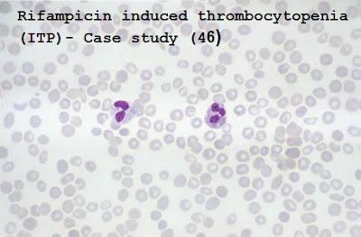 Case study (46) – Rifampicin induced thrombocytopenia (ITP)