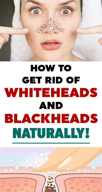 How to Manage a Persistent Form of Acne: Whiteheads and Blackheads