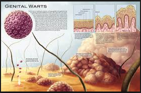 Penyakit Kutil Kelamin