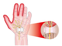 Soft Tissue Injuries Can be More Serious than They First Seem