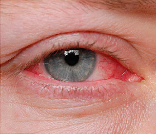 Conjunctivitis