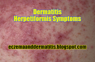 Dermatitis Herpetiformis Symptoms