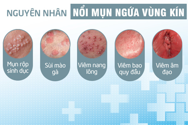 nổi mụn ngứa vùng kín