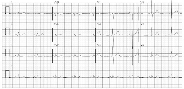 EKG