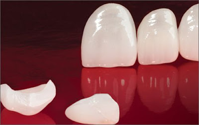 Răng sứ không kim loại cao cấp Zirconia