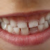Apperance of Milk-Teeth