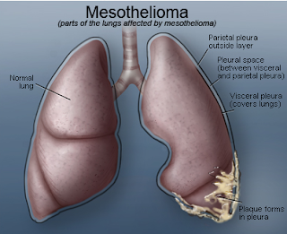 Mesothelioma is an aggressive cancer affecting the membrane lining of the lungs and abdomen.