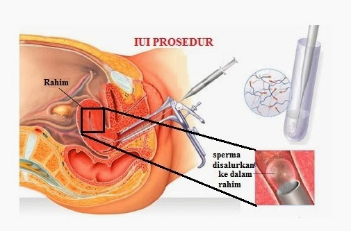 Ubat Punca Kencing Kotor - Sinter B