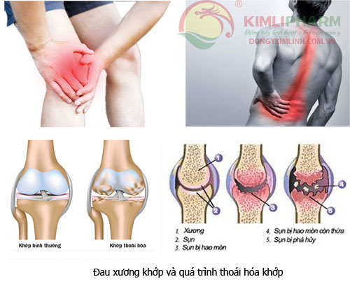 Các bệnh xương khớp thường gặp