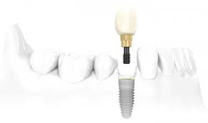 Nguyên nhân gây mất răng cần trồng Implant
