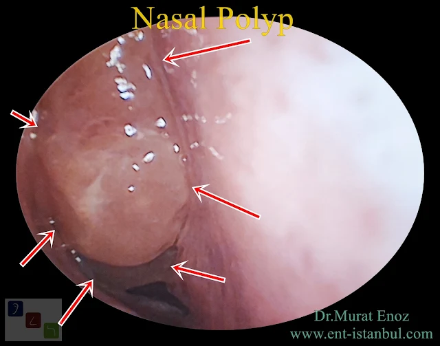 nasal congestion,nasal polyp,nasal polyposis