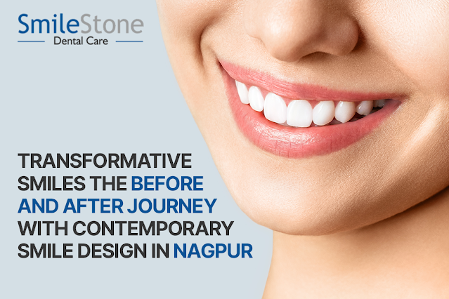 Best Smile Design in Nagpur